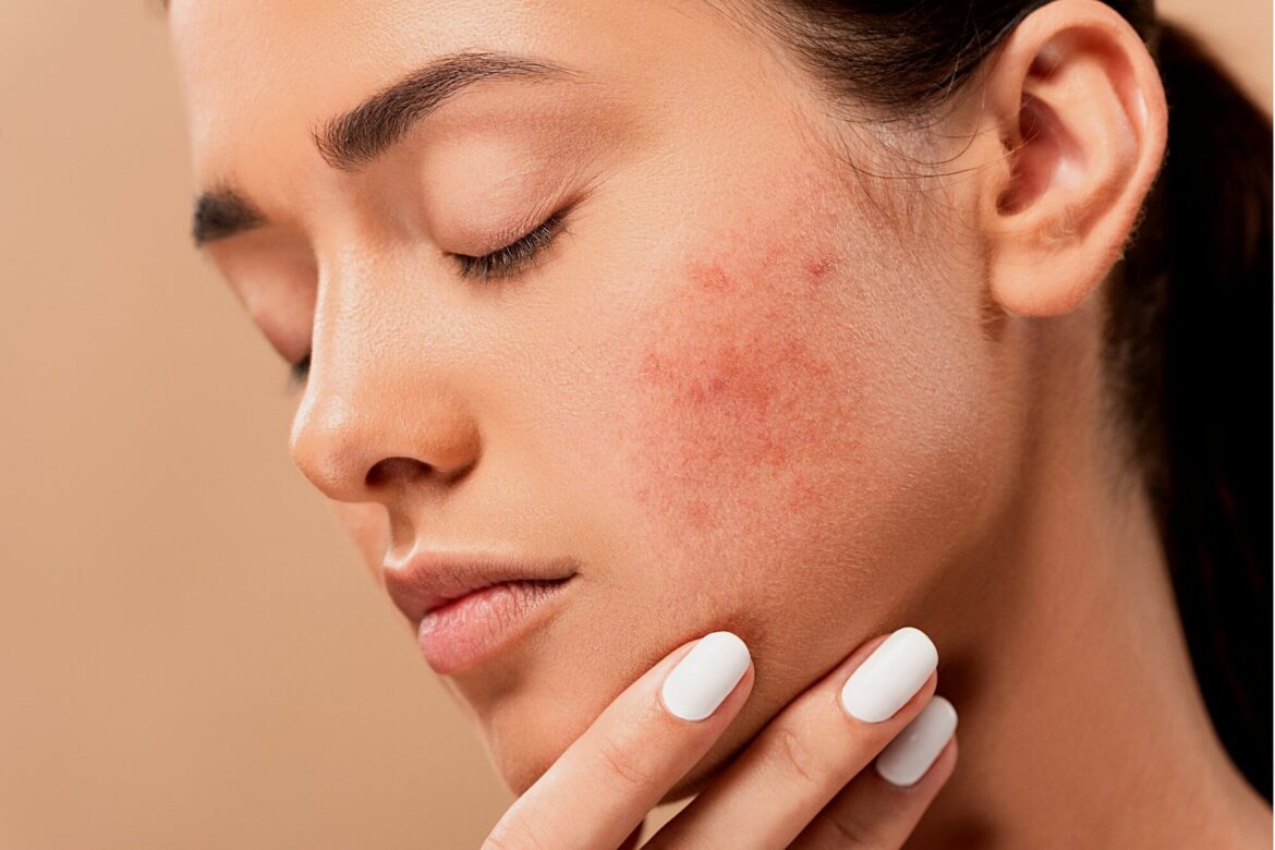 recurring acne