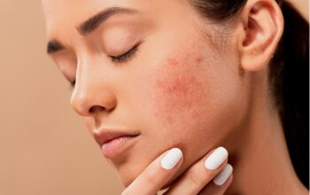 Recurring Acne On The Same Spot And How To Deal With It