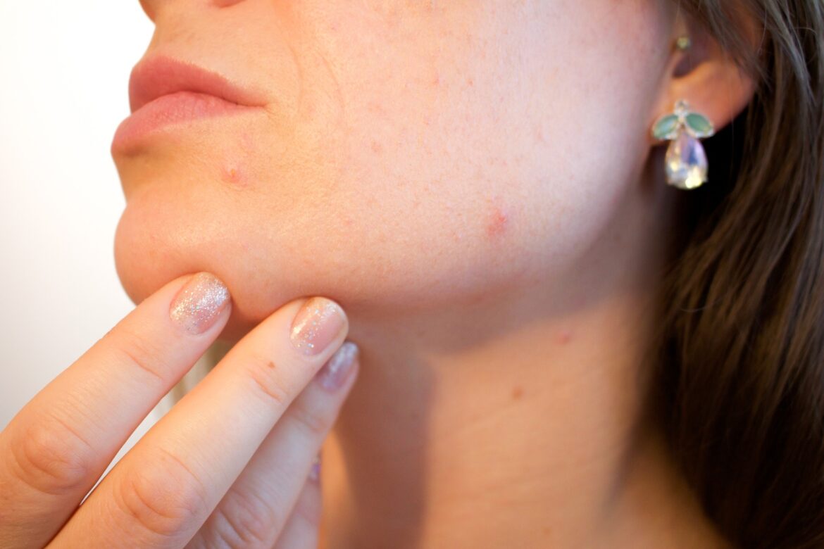 anti acne tips