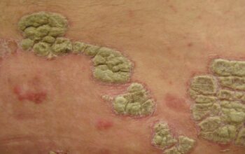 Treatment Options For Psoriasis