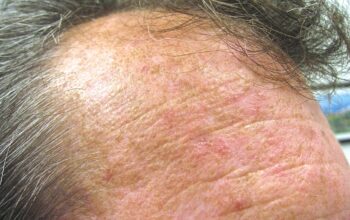 Skin Damage and Skin Cancer – Are Your Problems Related to the Sun?